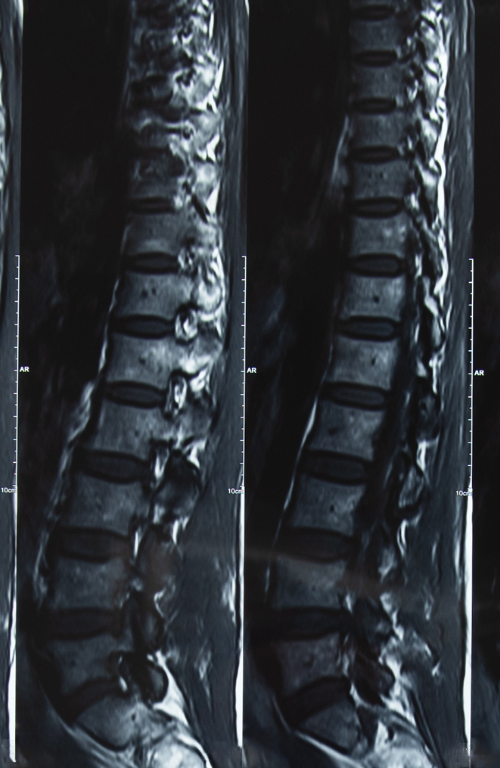 Discseel® Procedure 6