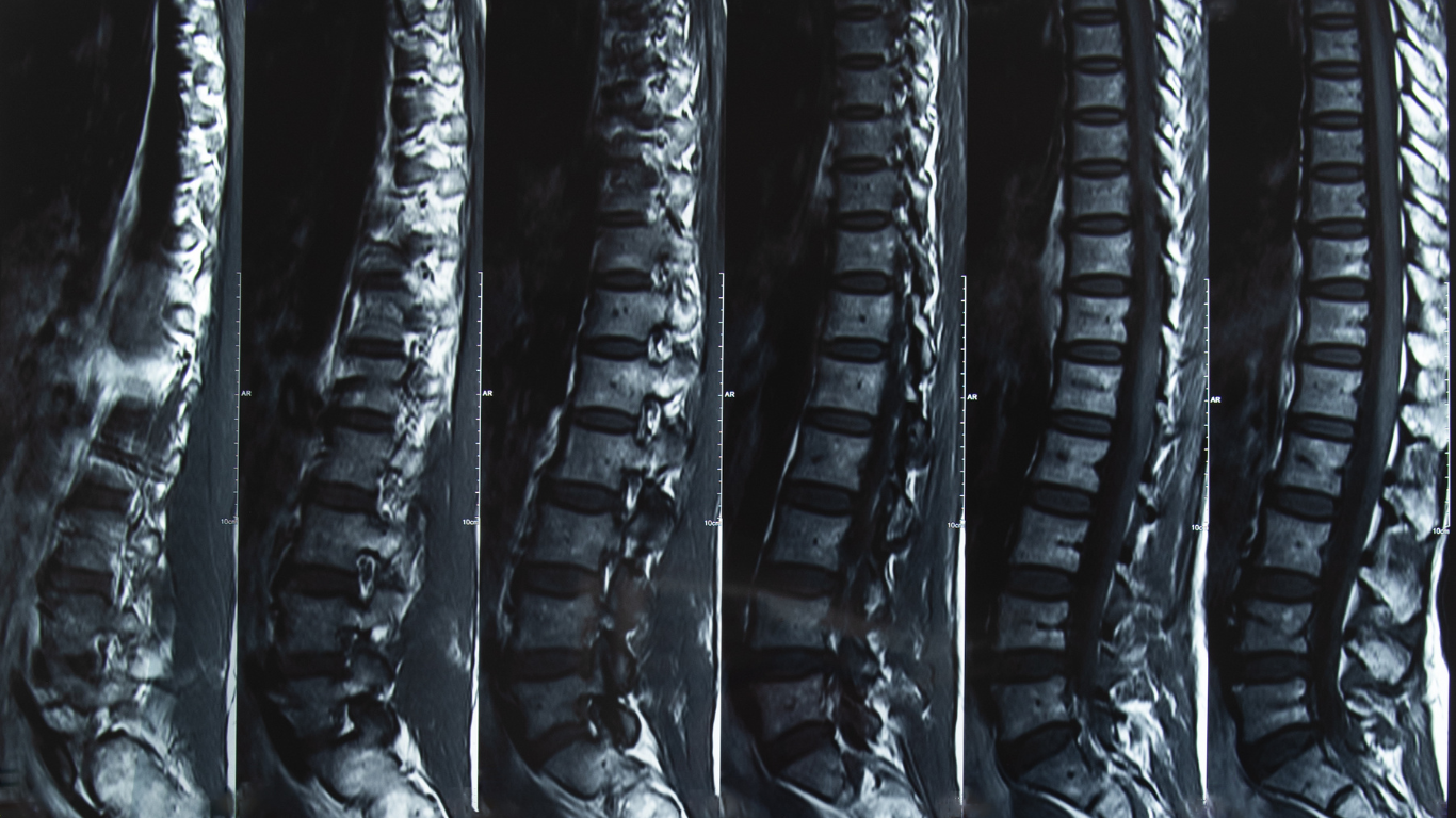 ​​CT Scan Herniated Disc