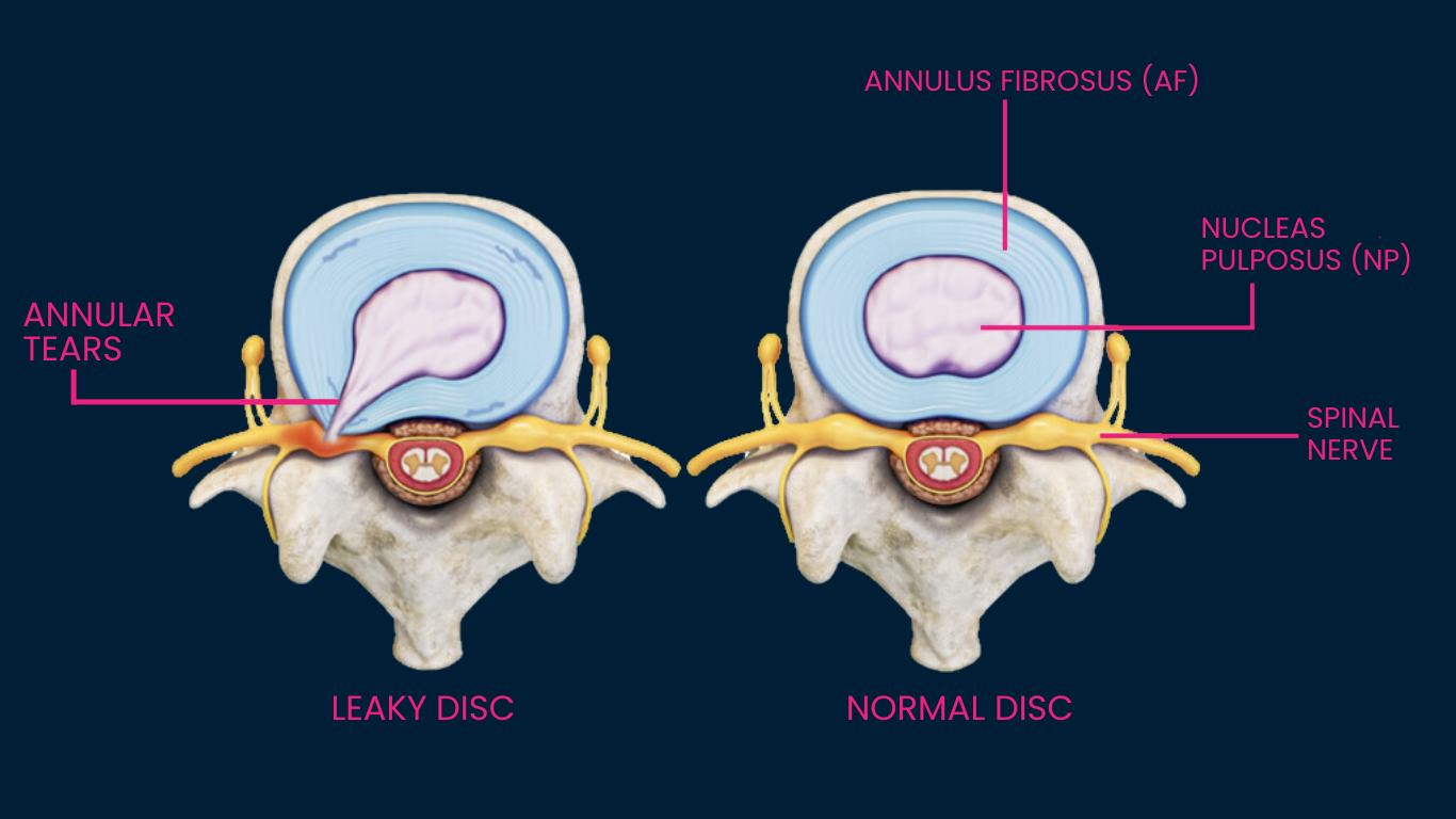 Discseel® Procedure 10