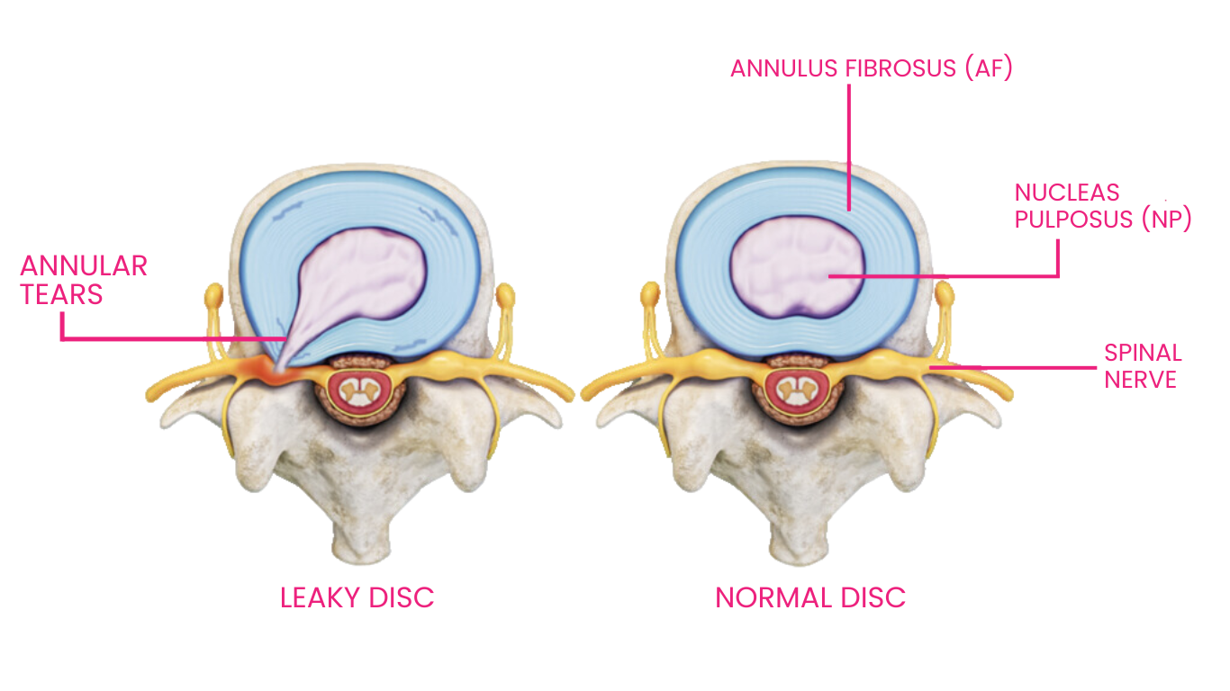 Discseel® Procedure 9